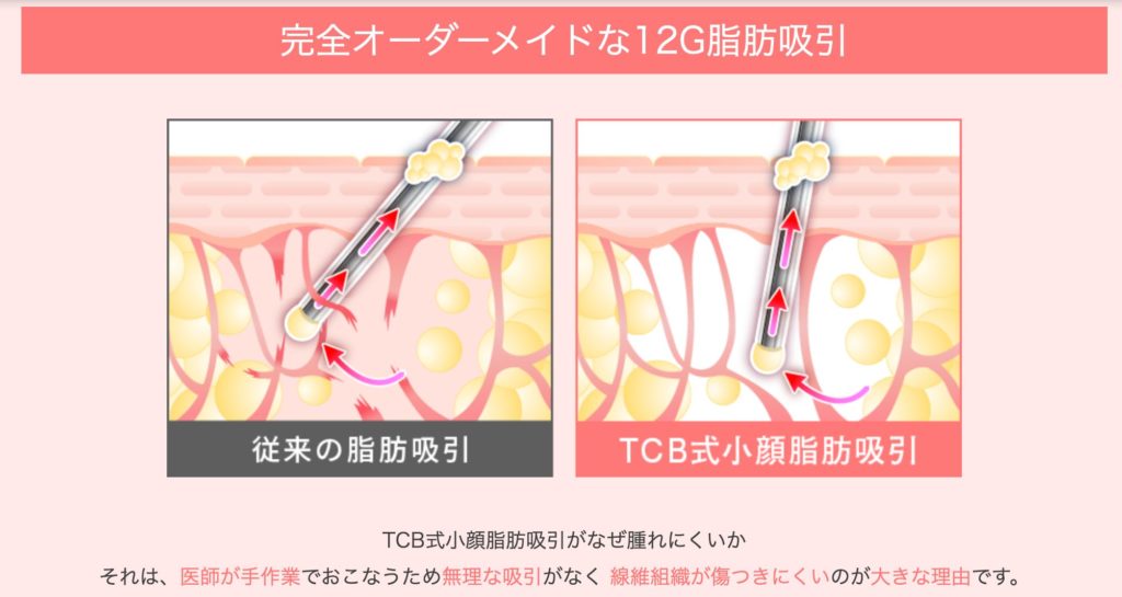 TCB　注射針　脂肪吸引注射
